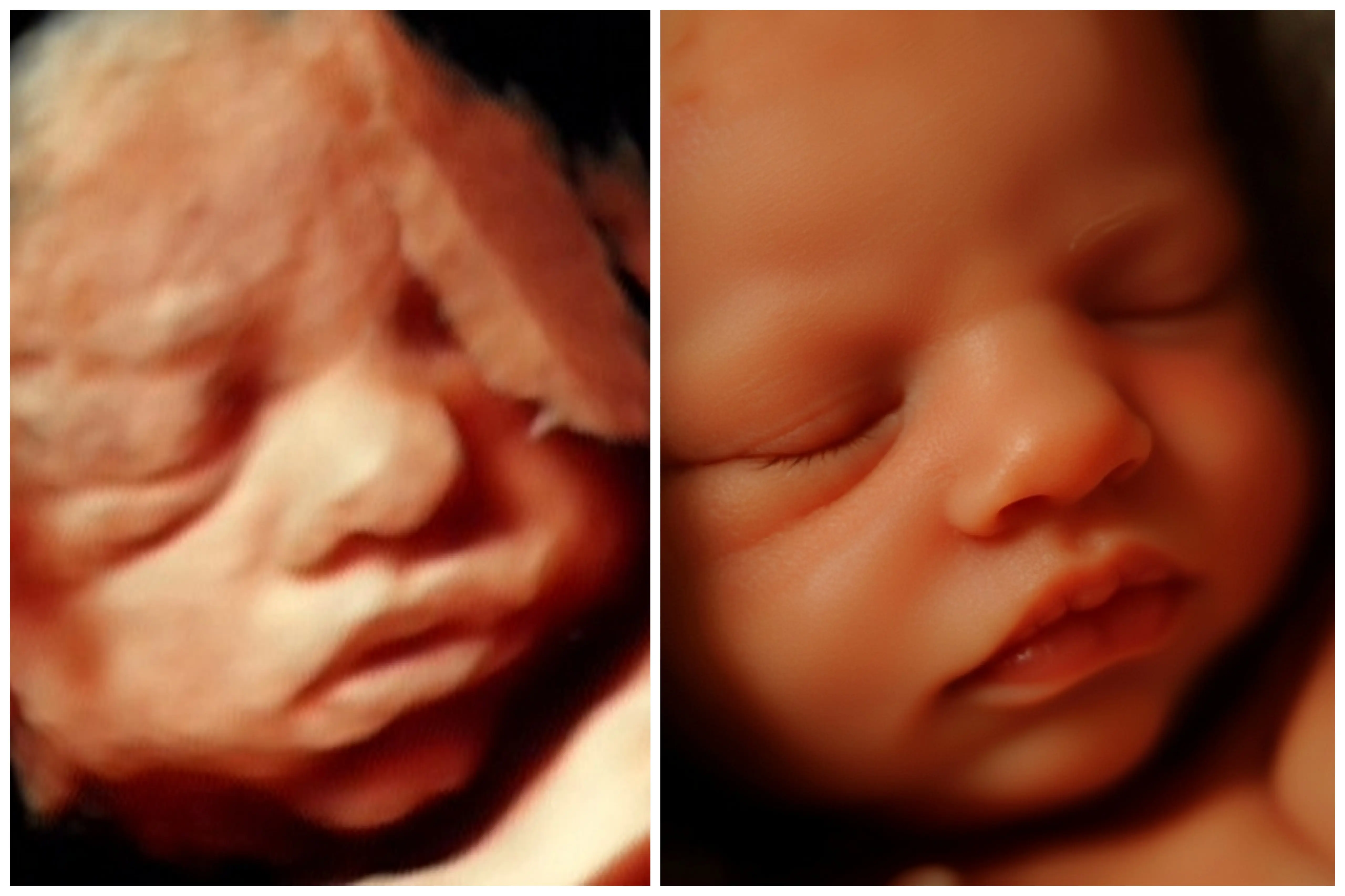 Ecografía 8K econatal