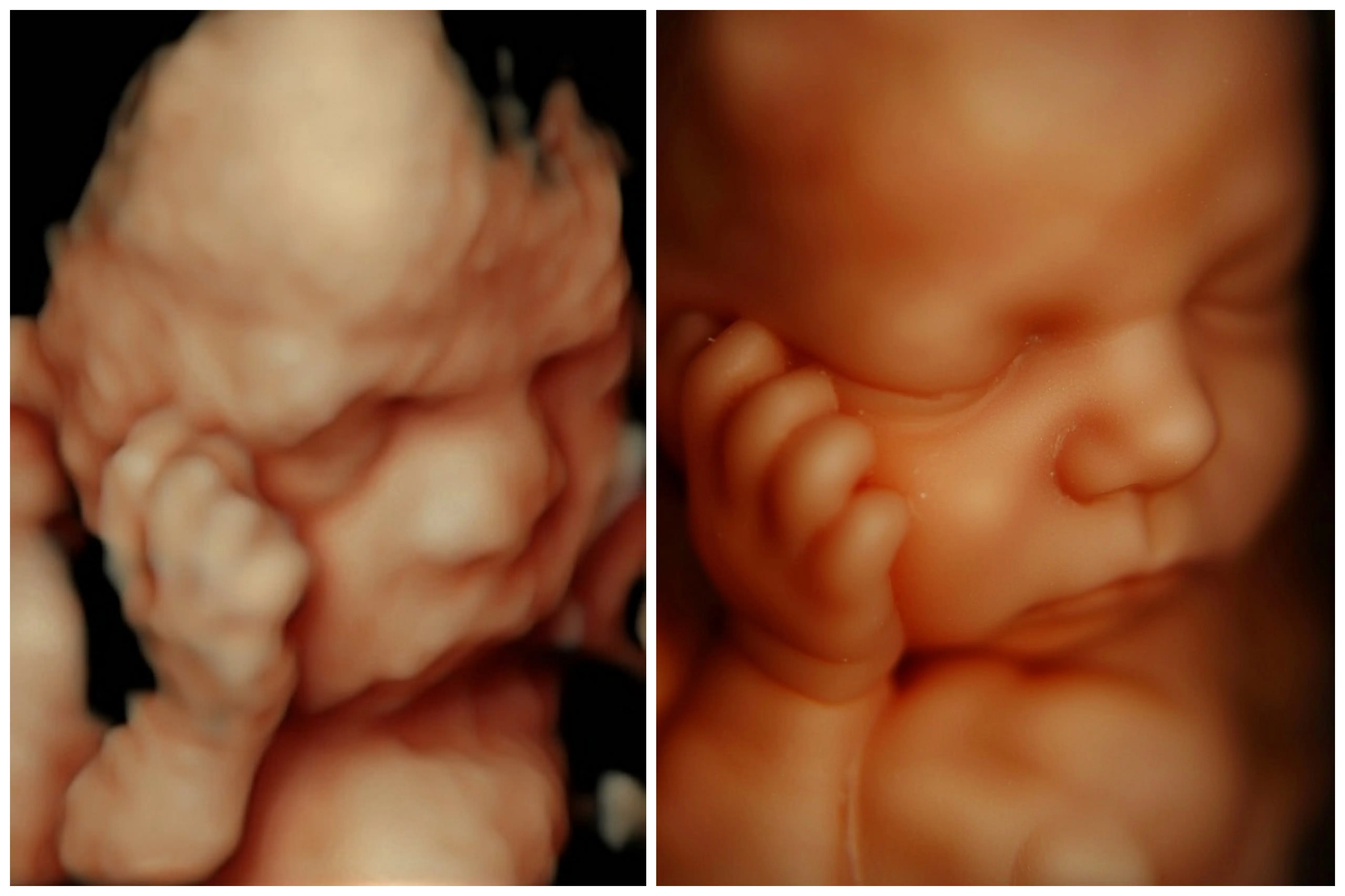 Ecografía 8K con IA - Nitidez extrema