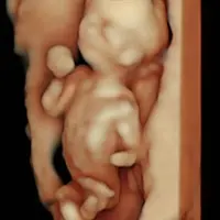 Procesamiento de imagen con IA para ecografía hiperrealista 8K